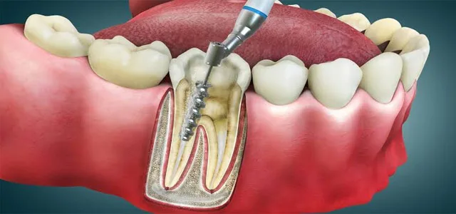 Endodoncia en OMI Dental
