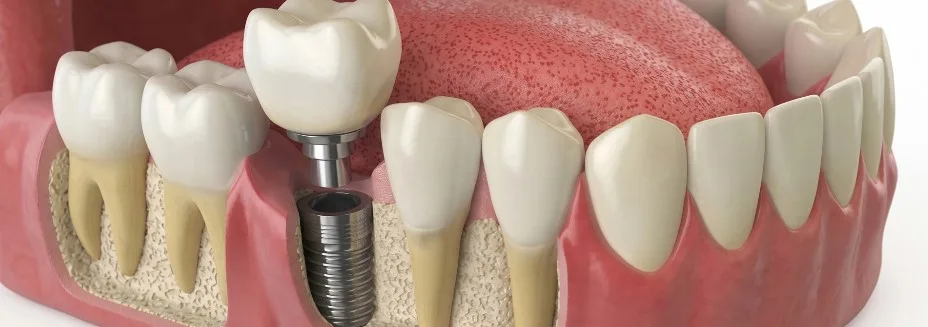 Implantes en OMI Dental