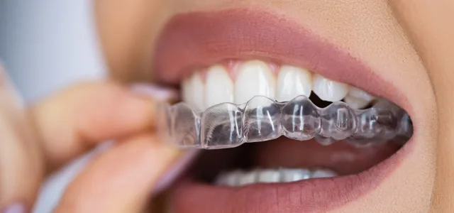 Ortodoncia en OMI Dental