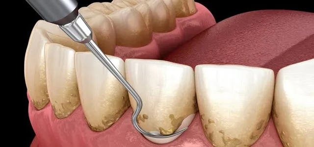 Periodoncia en OMI Dental