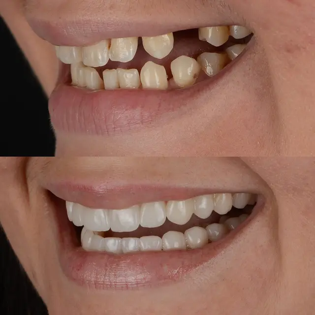 Paciente de OMI Dental antes del tratamiento